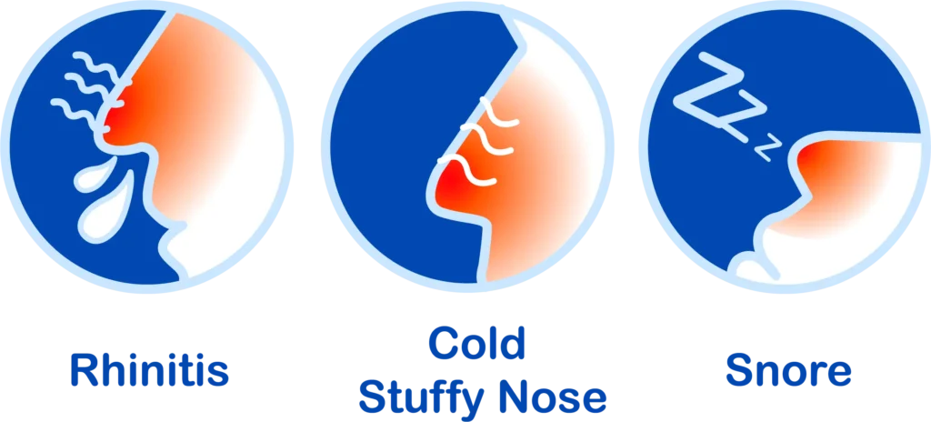 Illustration of rhinitis