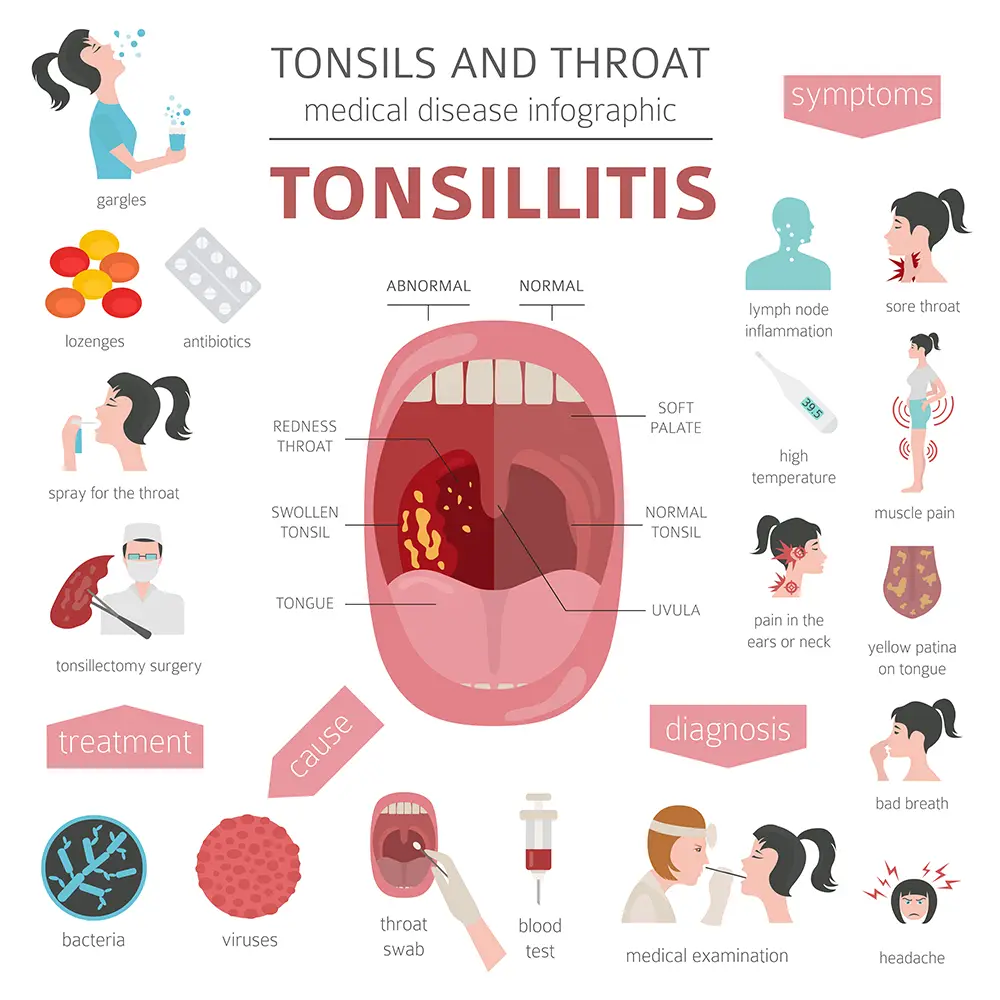Graphic showing treatments and symptoms for tonsillitis